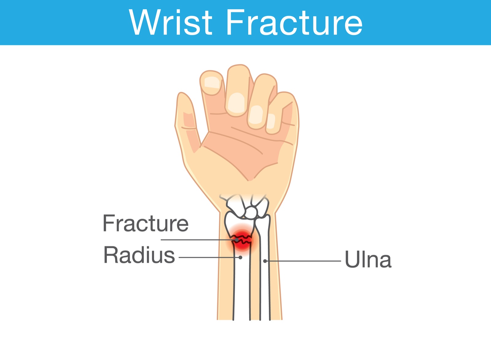 Distal Radius Fracture Signs, Symptoms, Causes, and Treatment Options